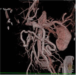 Encased Superior Mesenteric Vein (SMV) With Collaterals - CTisus CT Scan