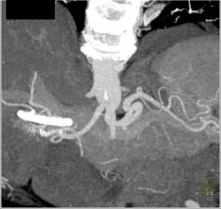 Aneurysm Proximal Celiac Artery With Focal Dissection - CTisus CT Scan