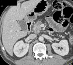 Subtle Adenocarcinoma Pancreas - CTisus CT Scan