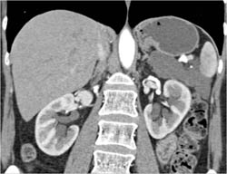 Lymphangioma - CTisus CT Scan