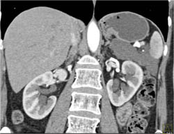 Lymphangioma - CTisus CT Scan