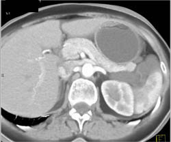 Lymphangioma - CTisus CT Scan