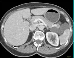 Lymphangioma - CTisus CT Scan