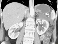 Lymphangioma - CTisus CT Scan