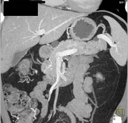 Multiple Intraductal Papillary Mucinous Neoplasms (IPMNs) - CTisus CT Scan