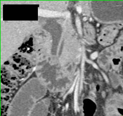 1 Cm Ampullary Mass - CTisus CT Scan