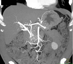 Chronic Pancreatitis - CTisus CT Scan