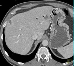 Collaterals Around Stomach Due to Splenic Vessel Occlusion - CTisus CT Scan