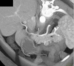 1 Cm Islet Cell Projects Off Body of the Pancreas - CTisus CT Scan