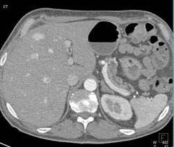 Islet Cell Tumor With Liver Matastases - CTisus CT Scan