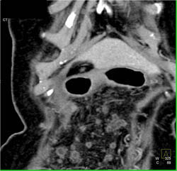 Pancreatic Cancer With Implants on the Omentum - CTisus CT Scan