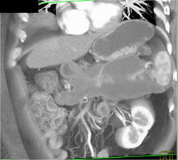 Pancreatic Necrosis With Splenic Vein Occlusion - CTisus CT Scan