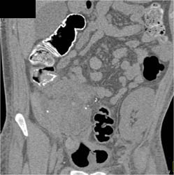 Pancreatic Transplant - CTisus CT Scan