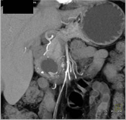 Pseudocyst - CTisus CT Scan