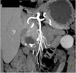 Pseudocyst - CTisus CT Scan