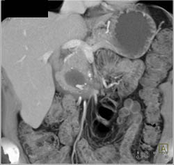 Pseudocyst - CTisus CT Scan