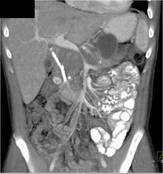 Pancreatic Cancer Encases the PV/SMV - CTisus CT Scan