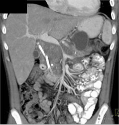 Pancreatic Cancer Encases the PV/SMV - CTisus CT Scan