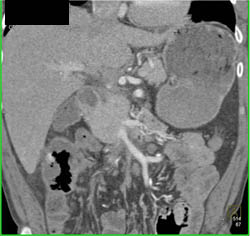 Pancreatic Cancer Encases the PV/SMV - CTisus CT Scan