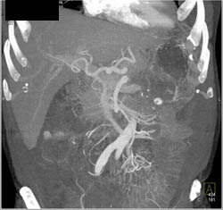 Pancreatic Cancer Encases the PV/SMV - CTisus CT Scan