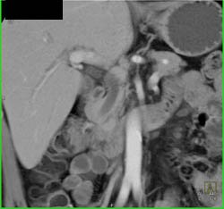 Ampullary Tumor - CTisus CT Scan