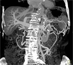 Tumor in Tail of Pancreas Occludes the Splenic Vein - CTisus CT Scan