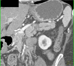 Subtle Tumor of the Body of the Pancreas - CTisus CT Scan