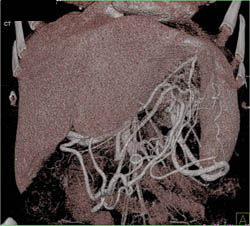 Collaterals Due to Splenic Vein Occlusion Due to Pancreatic Cancer - CTisus CT Scan