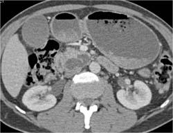 Intraductal Papillary Mucinous Neoplasm (IPMN) - CTisus CT Scan