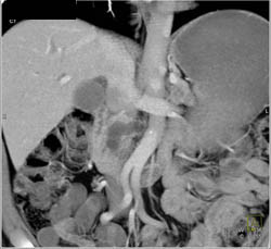 Intraductal Papillary Mucinous Neoplasm (IPMN) - CTisus CT Scan