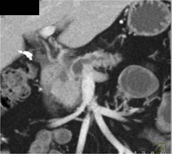 Intraductal Papillary Mucinous Neoplasm (IPMN) - CTisus CT Scan