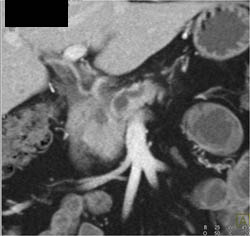 Intraductal Papillary Mucinous Neoplasm (IPMN) - CTisus CT Scan