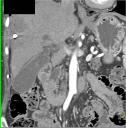 Biliary Stent With Ampullary Tumor - CTisus CT Scan