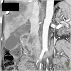 Hepatic Abscess and Pancreatic Tumor - CTisus CT Scan