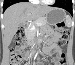 Subtle Islet Cell Tumor of the Pancreatic Head - CTisus CT Scan