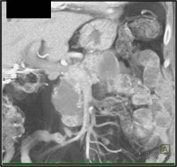 Cystadenoma - CTisus CT Scan