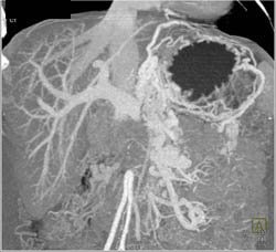 Pancreatic Cancer Encases PV/SMV With Collaterals - CTisus CT Scan