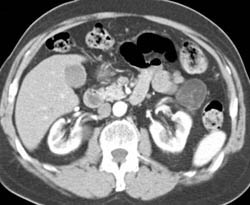 Lymphoepithelial Cyst - CTisus CT Scan