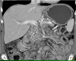 Portal Vein (PV) Thrombosis and Chronic Pancreatitis - CTisus CT Scan