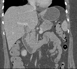 Cystic Pancreatic Mass- Cystadenoma- Pancreatic Mass Was Due to Angiomyolipoma (AML) - Leukemia - CTisus CT Scan