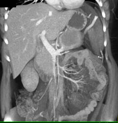 Pancreatic Lymphoma - CTisus CT Scan