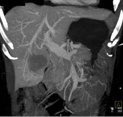 Pancreatic Cancer Encases the PV/SMV With Liver Metastases - CTisus CT Scan