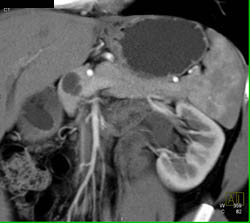 Intraductal Papillary Mucinous Neoplasm (IPMN) - CTisus CT Scan