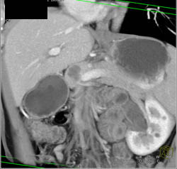 Intraductal Papillary Mucinous Neoplasm (IPMN) - CTisus CT Scan