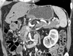 Splenic Tissue- in Tail of Pancreas - CTisus CT Scan