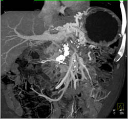 Chronic Pancreatitis Occludes PV/SMV - CTisus CT Scan