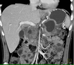 Chronic Pancreatitis With Encased PV/SMV - CTisus CT Scan