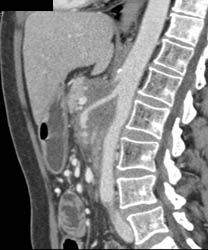 Encased SMA and Celiac Arteries Due to Pancreatic Cancer - CTisus CT Scan