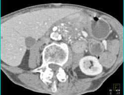 Chronic Pancreatitis - CTisus CT Scan