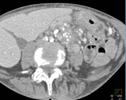 Chronic Pancreatitis - CTisus CT Scan